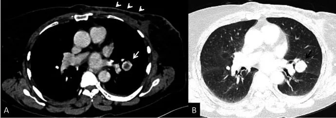 A patient, who was diagnosed with Stage IV Breast Cancer