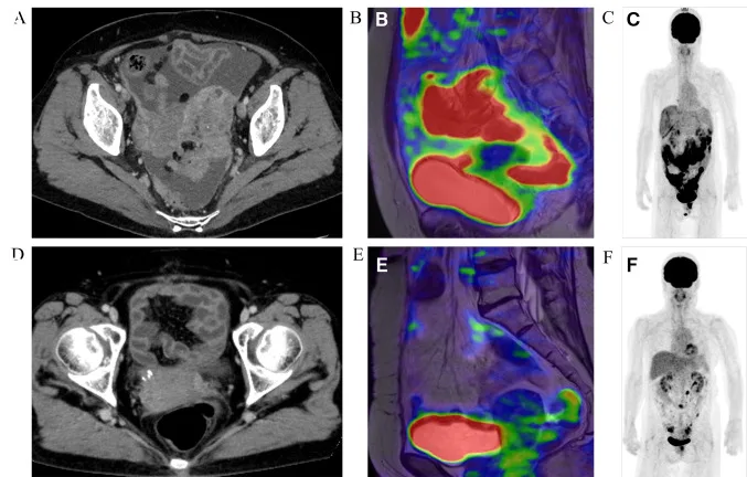A patient, who was diagnosed with Ovarian Cancer