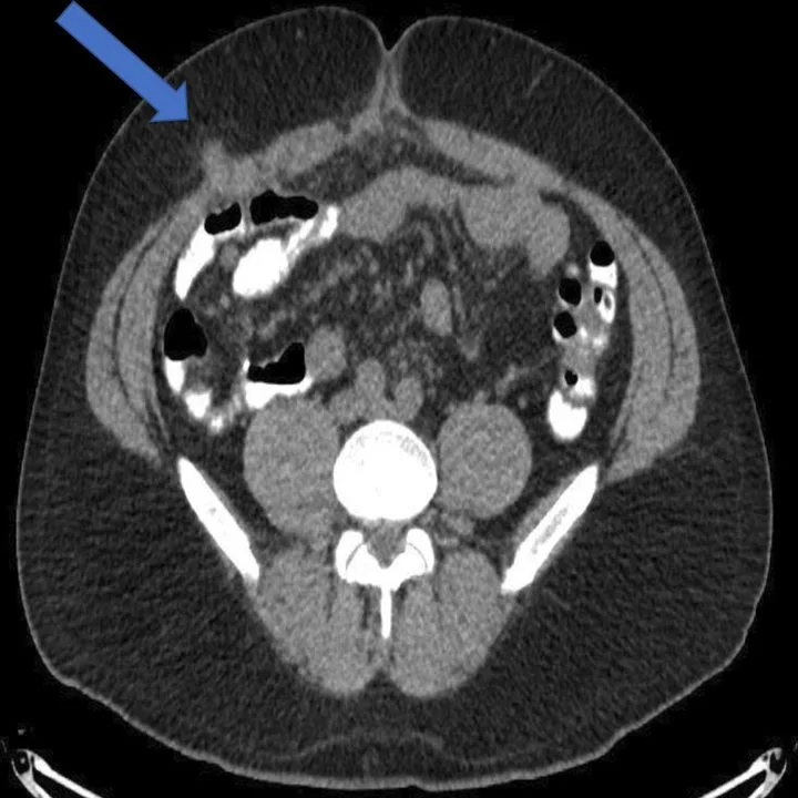 A patient, who was diagnosed with Colorectal Adenocarcinoma