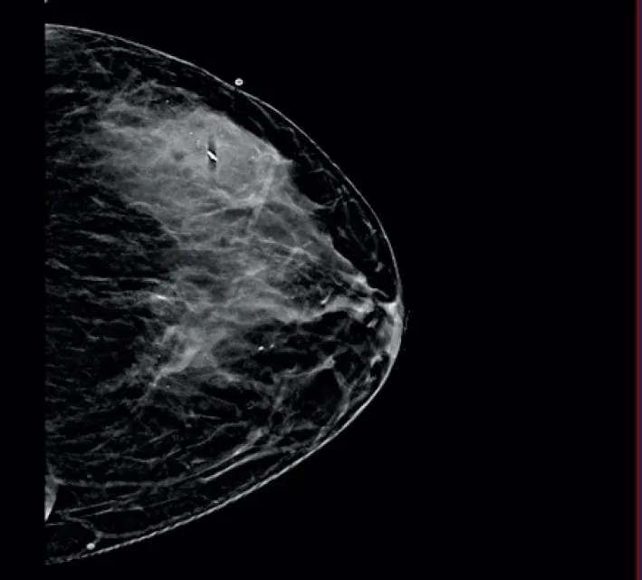 A patient, who was diagnosed with Breast Squamous Cell Carcinoma