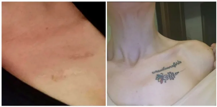 A patient, who was diagnosed with Breast Cancer