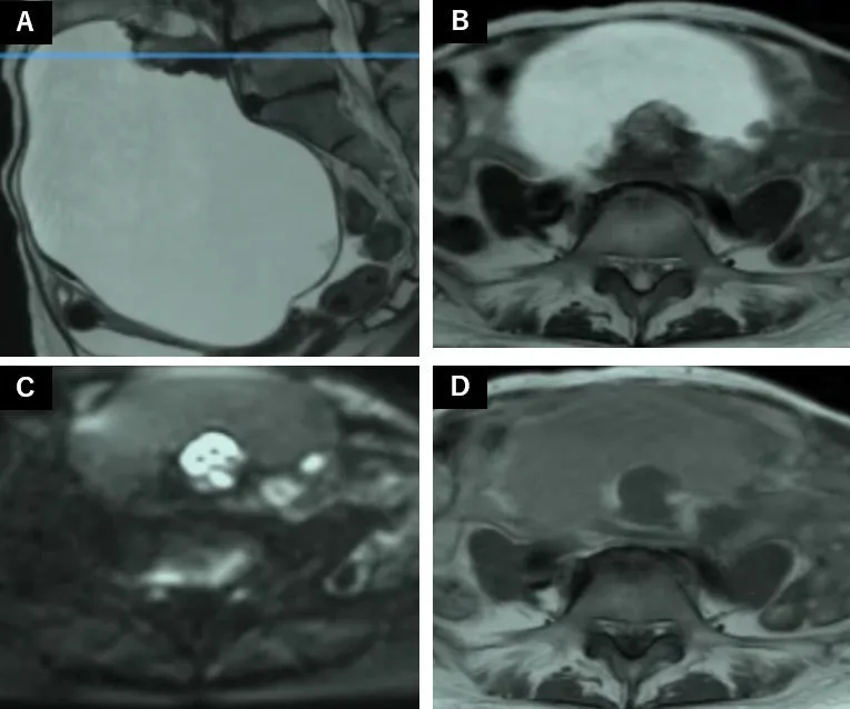 A patient, who was diagnosed with Ovarian Cancer
