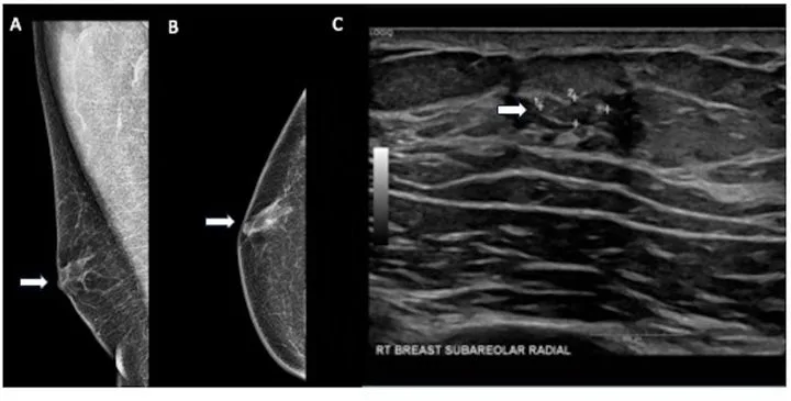 A patient, who was diagnosed with Invasive Ductal Carcinoma