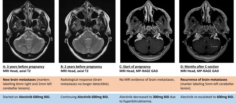 A patient, who was diagnosed with Stage IV Lung Adenocarcinoma