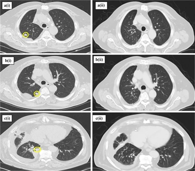 A patient, who was diagnosed with Stage IV Lung Adenocarcinoma