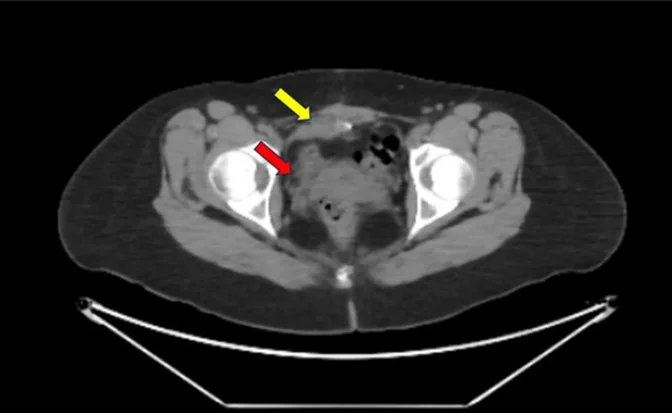 A patient, who was diagnosed with Stage I Ovarian Cancer