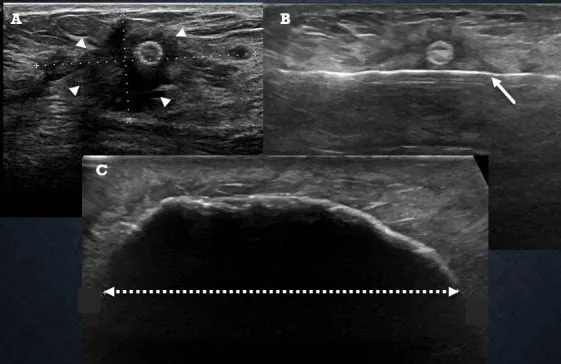 A patient, who was diagnosed with Invasive Ductal Carcinoma