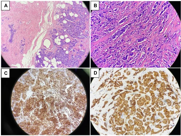 A patient, who was diagnosed with Breast Cancer