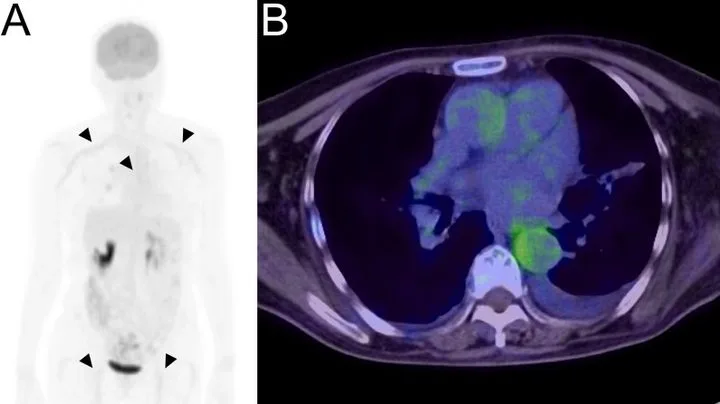 A patient, who was diagnosed with Stage IV Lung Adenocarcinoma