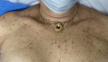 A patient, who was diagnosed with Stage IV Invasive Ductal Carcinoma