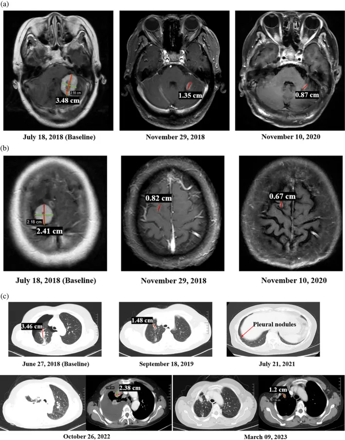 A patient, who was diagnosed with Stage IV Lung Adenocarcinoma