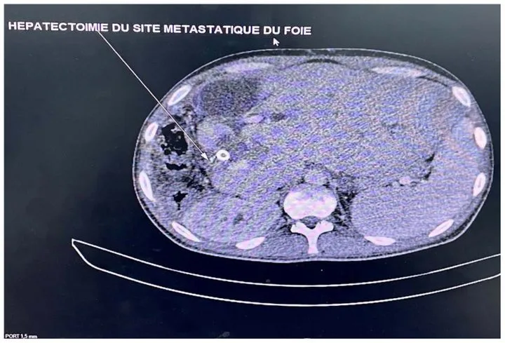 A patient, who was diagnosed with Stage IV Colorectal Adenocarcinoma