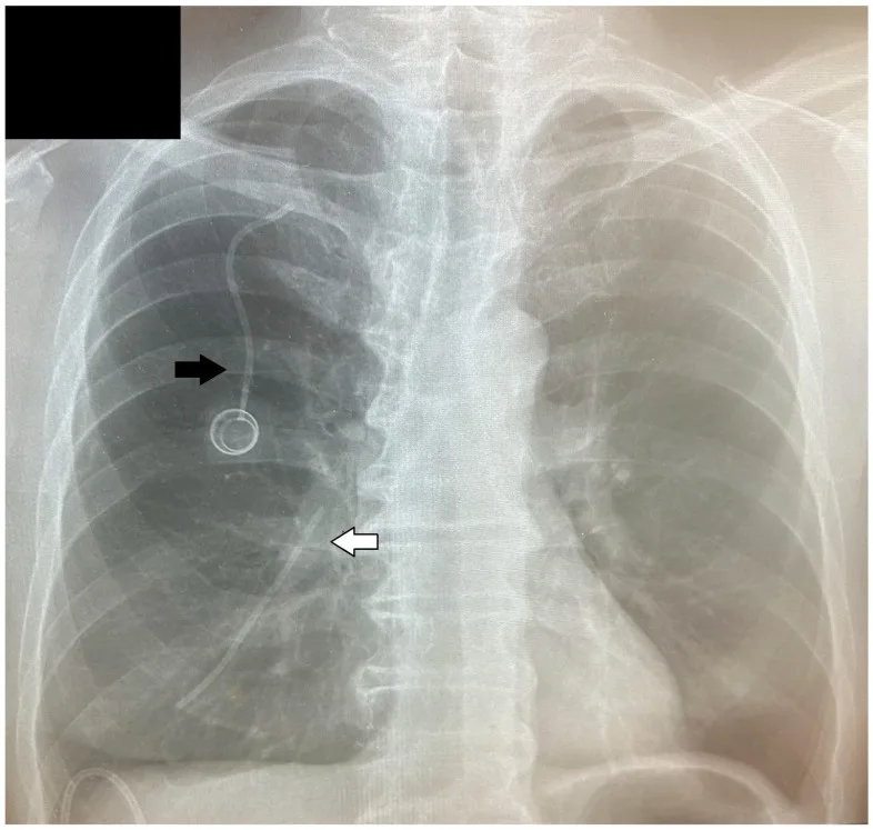 A patient, who was diagnosed with Stage IV Gastric Cancer