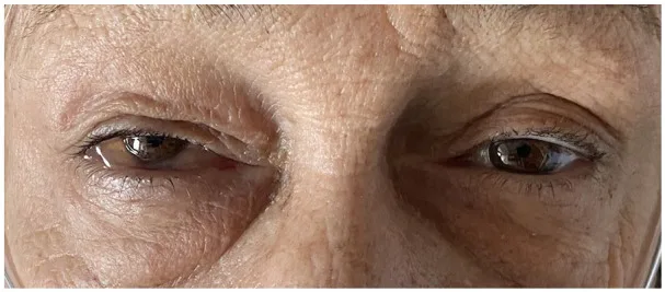 A patient, who was diagnosed with Stage I Breast Cancer