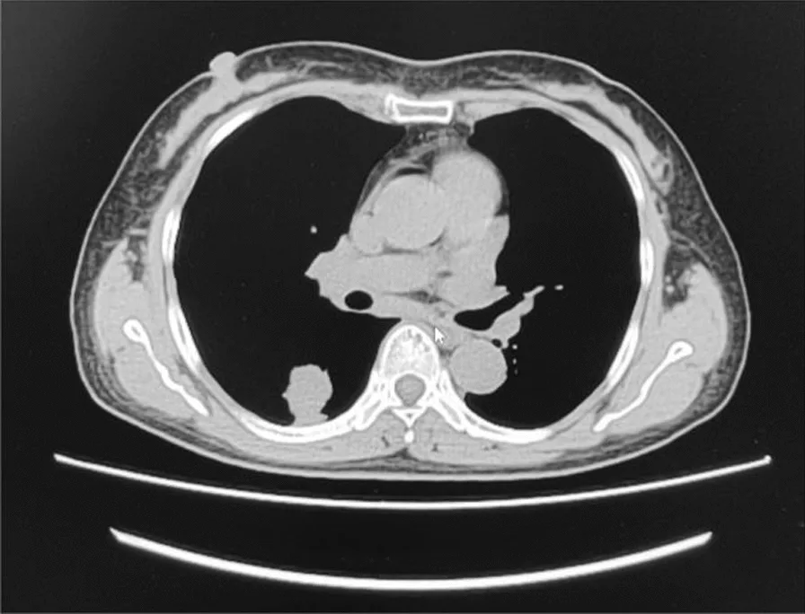 A patient, who was diagnosed with Stage IV Lung Cancer