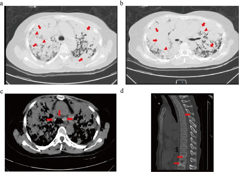 A patient, who was diagnosed with Stage IV Lung Adenocarcinoma