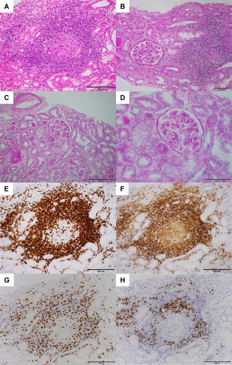 A patient, who was diagnosed with Lung Squamous Cell Carcinoma