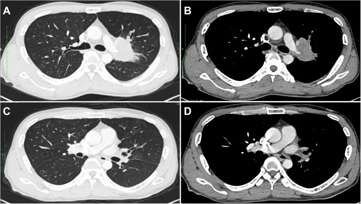 A patient, who was diagnosed with Stage III Lung Adenocarcinoma