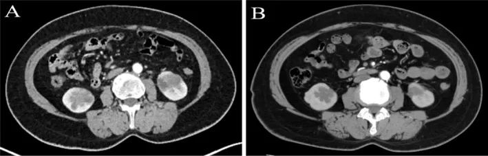 A patient, who was diagnosed with Stage IV Lung Adenocarcinoma