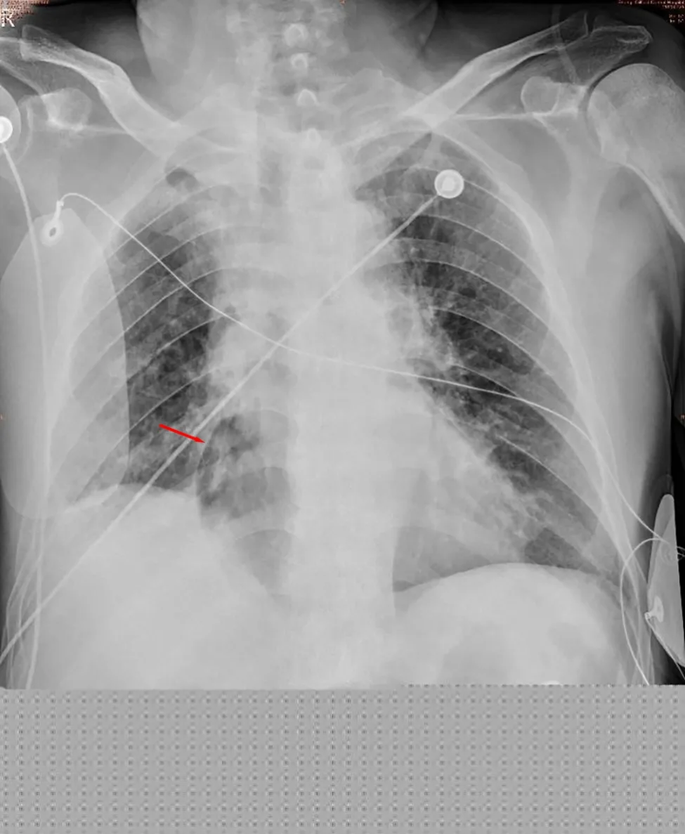 A patient, who was diagnosed with Stage II Lung Adenocarcinoma