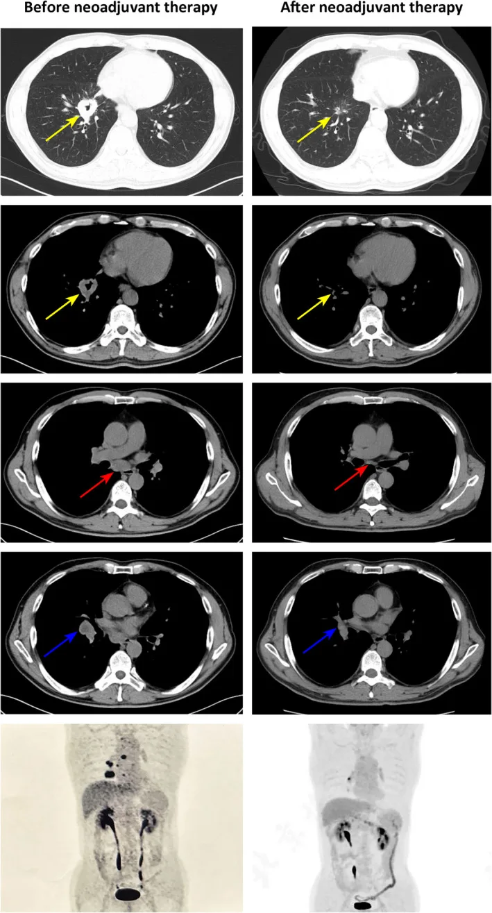 A patient, who was diagnosed with Stage I Lung Adenocarcinoma