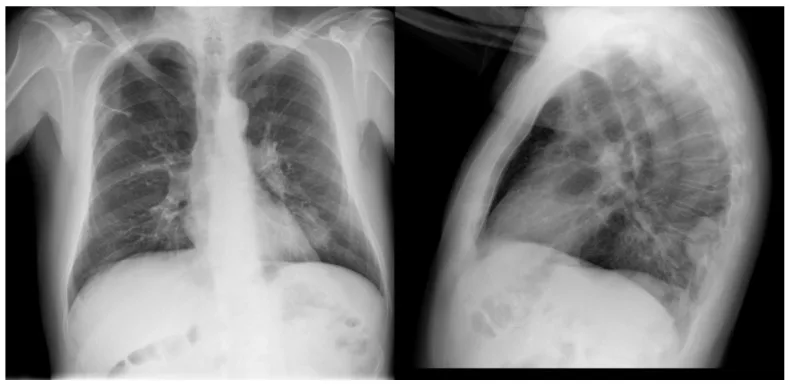 A patient, who was diagnosed with Stage IV Lung Adenocarcinoma
