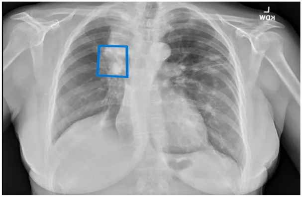A patient, who was diagnosed with Stage IV Lung Adenocarcinoma