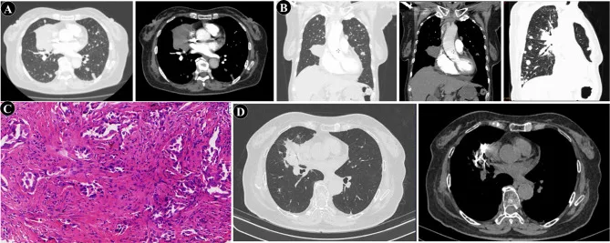 A patient, who was diagnosed with Stage IV Lung Adenocarcinoma