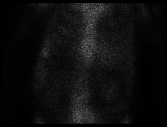 A patient, who was diagnosed with Lung Adenocarcinoma