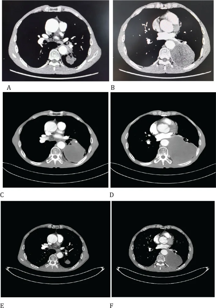 A patient, who was diagnosed with Stage III Lung Cancer