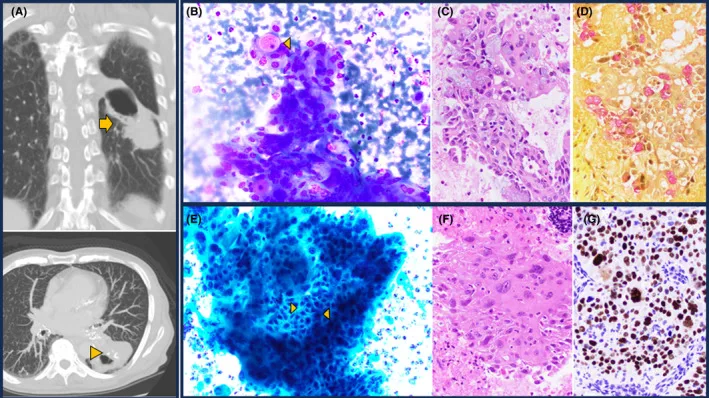 A patient, who was diagnosed with Lung Cancer