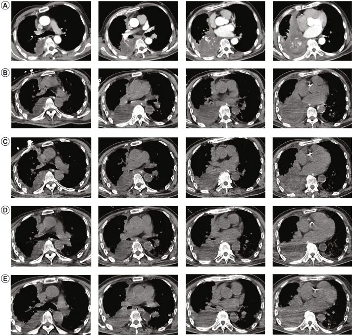 A patient, who was diagnosed with Stage IV Lung Adenocarcinoma