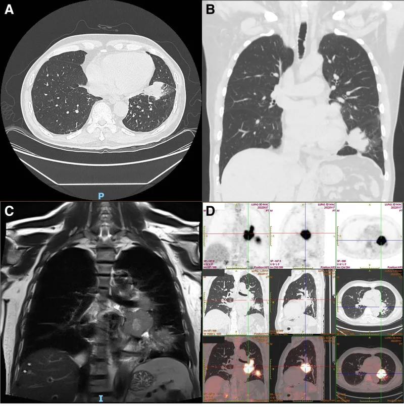 A patient, who was diagnosed with Stage IV Small Cell Lung Cancer