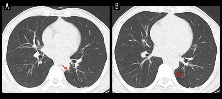 A patient, who was diagnosed with Stage III Lung Adenocarcinoma