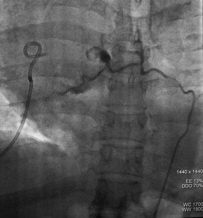 A patient, who was diagnosed with Lung Adenocarcinoma