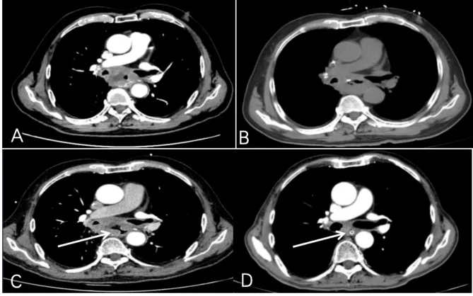 A patient, who was diagnosed with Stage IV Lung Squamous Cell Carcinoma