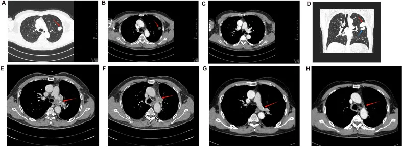 A patient, who was diagnosed with Stage III Lung Cancer