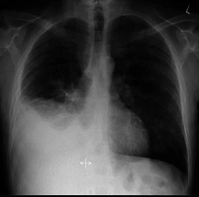 A patient, who was diagnosed with Stage IV Small Cell Lung Cancer