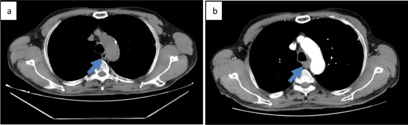 A patient, who was diagnosed with Lung Squamous Cell Carcinoma