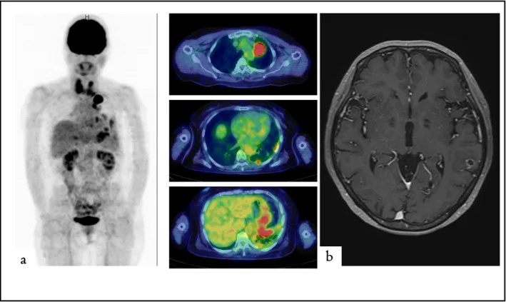 A patient, who was diagnosed with Stage IV Lung Adenocarcinoma