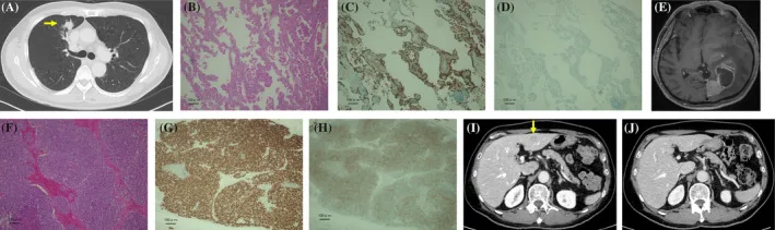 A patient, who was diagnosed with Stage IV Small Cell Lung Cancer