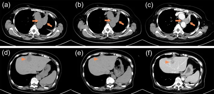 A patient, who was diagnosed with Stage IV Lung Adenocarcinoma