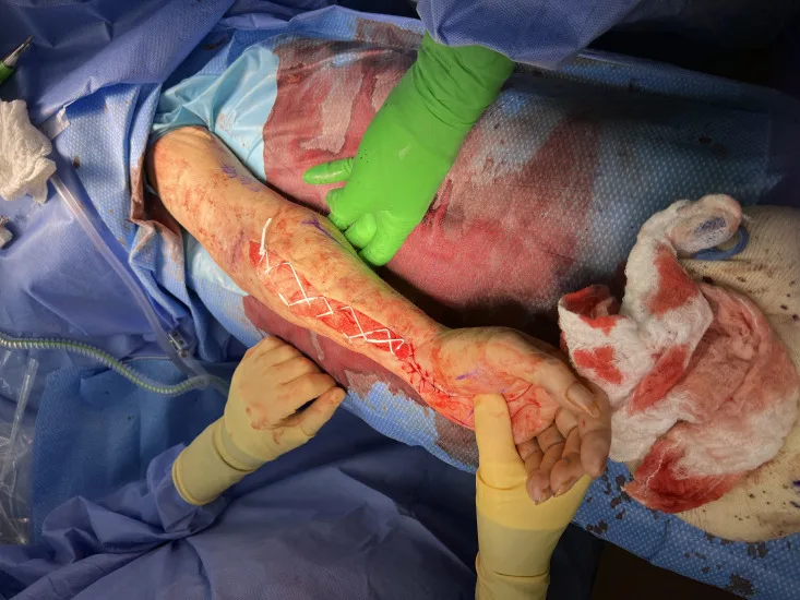A patient, who was diagnosed with Lung Adenocarcinoma