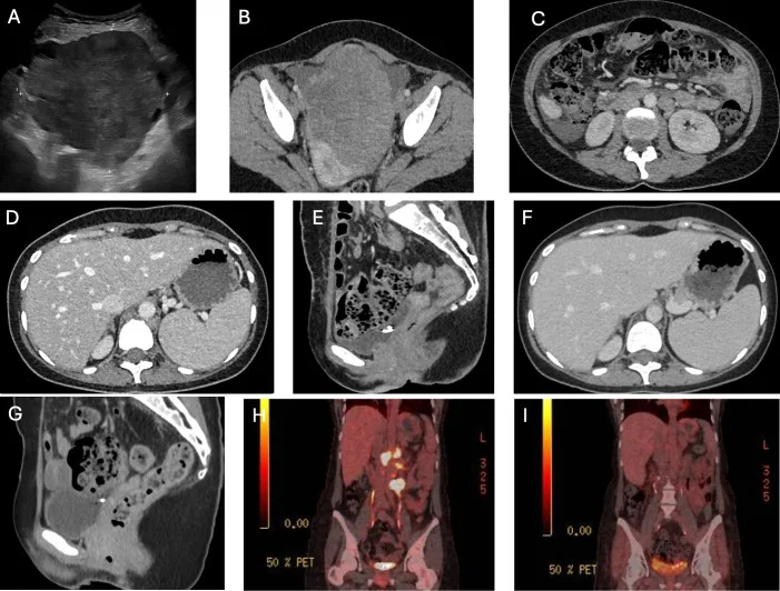A patient, who was diagnosed with Stage III Small Cell Lung Cancer