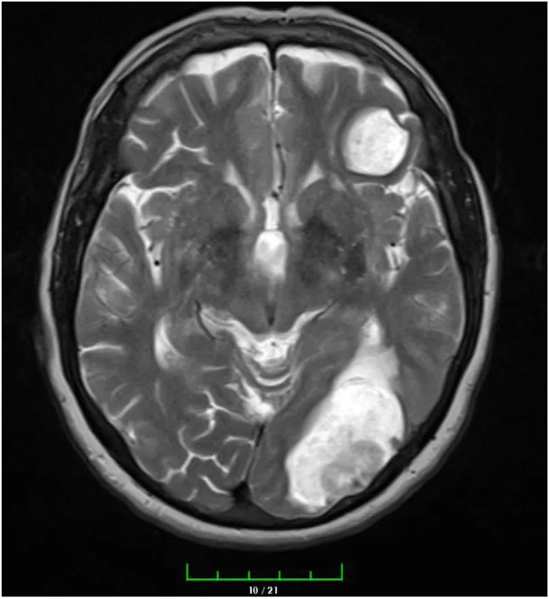 A patient, who was diagnosed with Stage IV Lung Adenocarcinoma