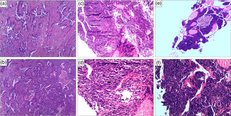 A patient, who was diagnosed with Stage IV Small Cell Lung Cancer