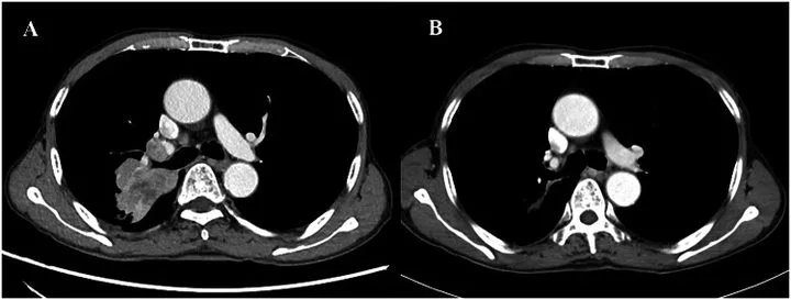 A patient, who was diagnosed with Lung Adenocarcinoma