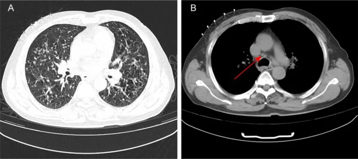 A patient, who was diagnosed with Stage IV Lung Adenocarcinoma
