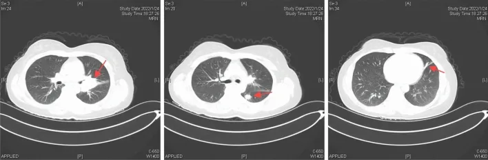 A patient, who was diagnosed with Stage IV Small Cell Lung Cancer