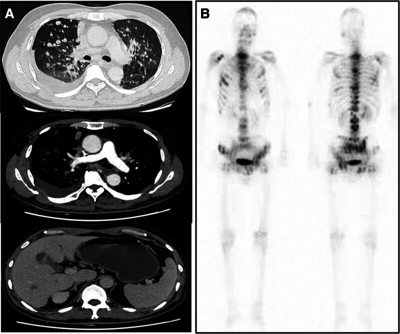 A patient, who was diagnosed with Stage IV Non-Small Cell Lung Cancer